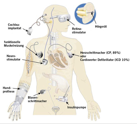 Abb. 1:   Verschiedene aktive medizinische Implantate (Quelle: DGUV Information 203-043)