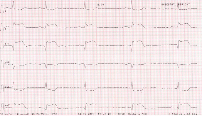 Abb. 1:    Extremitäten-EKG-Ableitungen