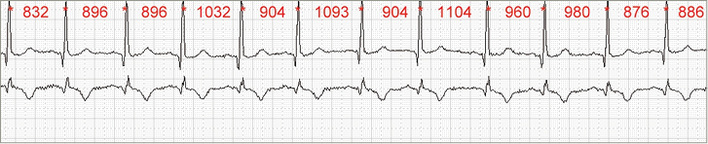 
 Abb. 1: 
 Prinzip der Ermittlung der NN-Intervalle aus dem EKG als Abstandsmaß zwischen zwei R-Zacken
