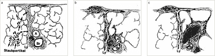 
 Abb. 1: 
 Pulmonale Staubaufnahme. 



a Phase der pulmonalen Staubaufnahme und der interstitiellen Inkorporation = Phase I. 



b Phase der Reaktion und Fibrose = Phase II. 



c Phase der Komplikationen = Phase III 



(A = Pulmonalarterie; Br = Bronchiolus; Ly = Lymphgefäß). Aus: Müller u. Grewe 1992



