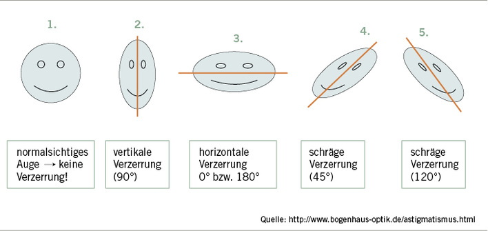 
 Abb. 1: 
 Astigmatismus – Korrektur mit Zylindergläsern
