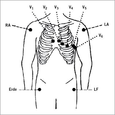 
 Abb. 1: 
 Platzierung der Brustwand- und Extremitätenelektrode beim Belastungs-EKG. V1: 4. ICR parasternal re.; V2: 4. ICR parasternal li.; V3: zwischen V2 und V4; V4: 5. ICR in der Medioklavikularlinie li. (normalerweise Herzspitze); V5: vordere Axillarlinie in Höhe von V4 li.; V6: mittlere Axillarlinie in Höhe von V4 li.
